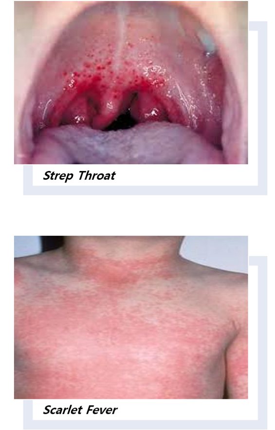 Scarlet Fever  Concise Medical Knowledge