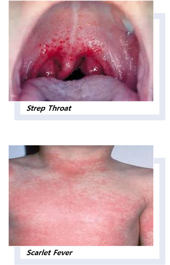 Group A Streptococcus and Scarlet Fever :: Hertfordshire and West Essex  Healthier Together